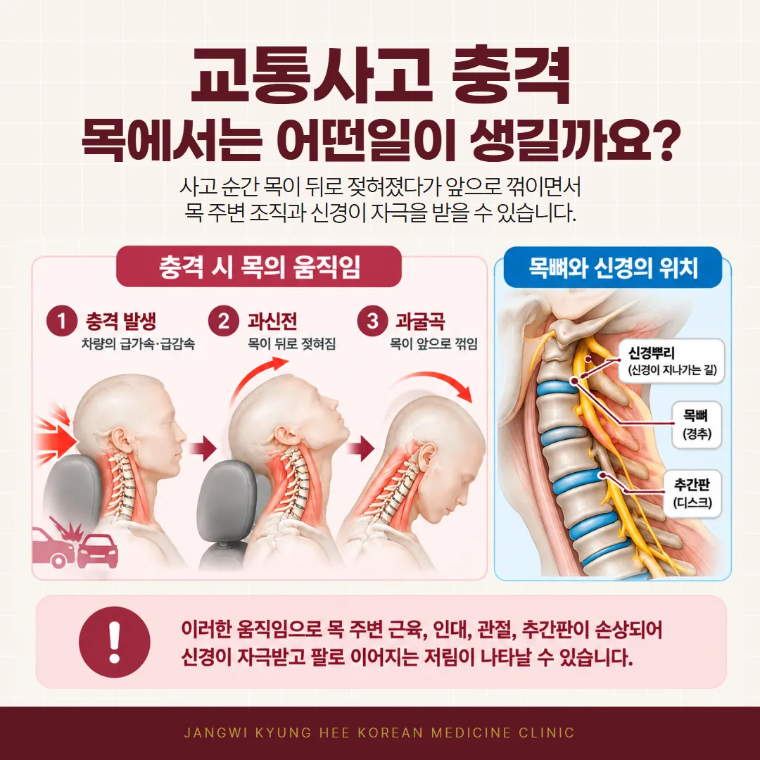 교통사고 편타성 손상에서 목이 과신전·과굴곡되는 과정과 경추 신경뿌리 위치를 보여주는 도식