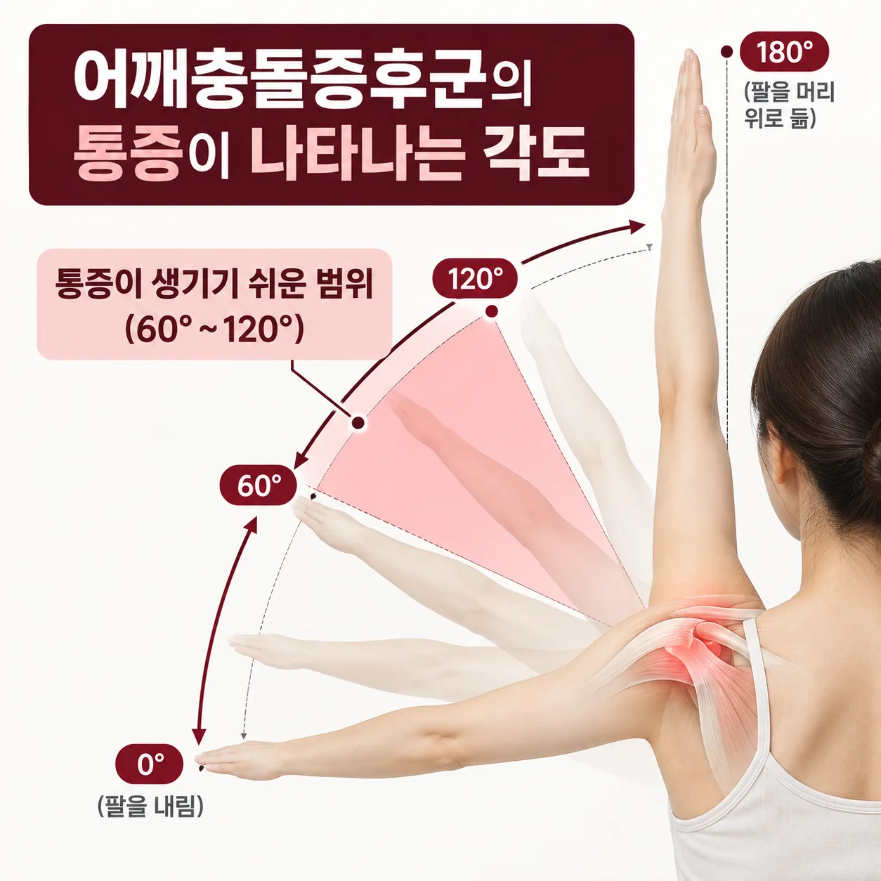 어깨충돌증후군에서 팔을 60도에서 120도 사이로 들 때 아픈 범위를 표시한 각도 개념도