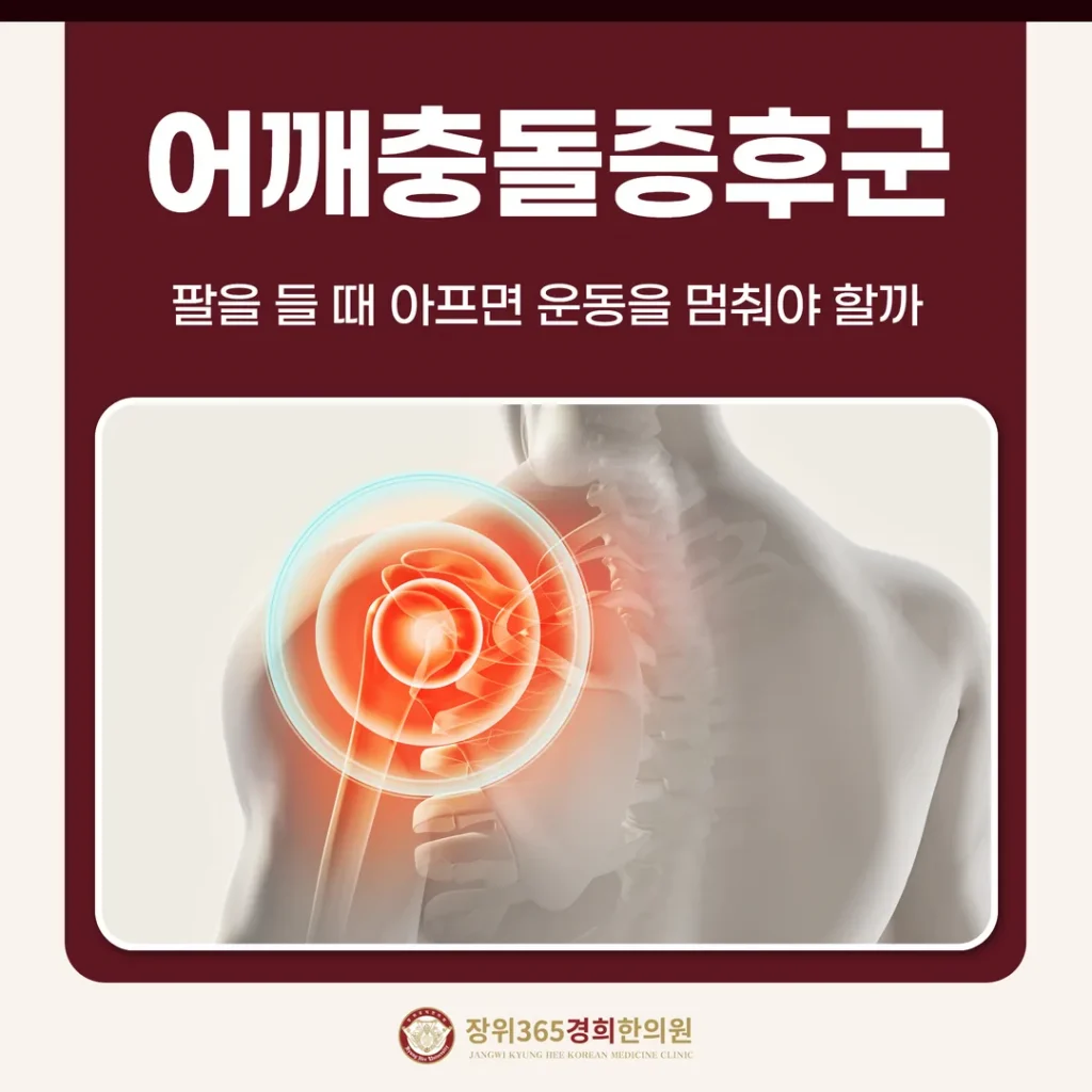 어깨충돌증후군, 팔을 들 때 아프면 운동을 멈춰야 할까