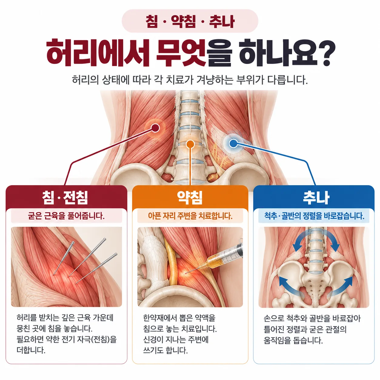 침 약침 추나가 허리에서 겨냥하는 곳을 나눠 표시한 개념도