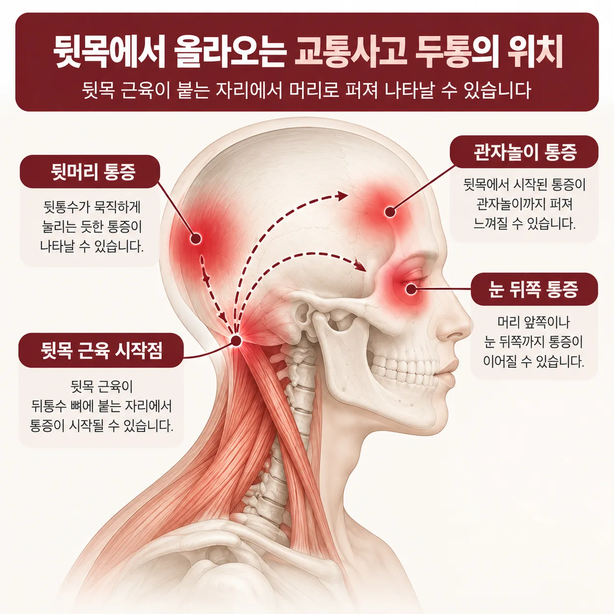 뒷목에서 뒷머리와 관자놀이로 올라오는 교통사고 두통 위치 도식